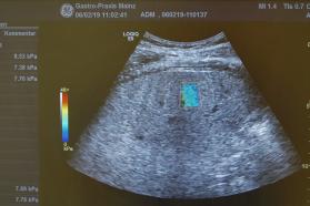 Ultraschallbild mit Farbdoppler aus einer gastroenterologischen Praxis zeigt die Darstellung eines inneren Organs mit farblich markiertem Bereich zur Durchblutungsmessung.