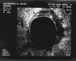 Endosonografisches Ultraschallbild aus einer Gastropraxis mit zentrisch schwarzem Rundbild